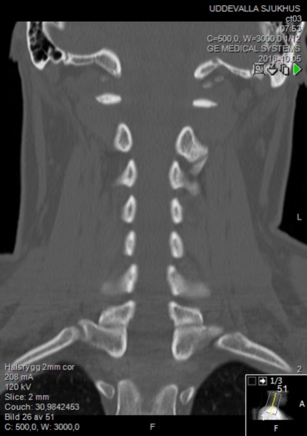 Eine MRT-Aufnahme des Halses eines Mannes mit einer sichtbaren Fraktur, die auf einem Computerbildschirm angezeigt wird.